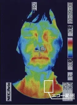 鍼治療で治った突発性難聴の顔のサーモグラフィ画像