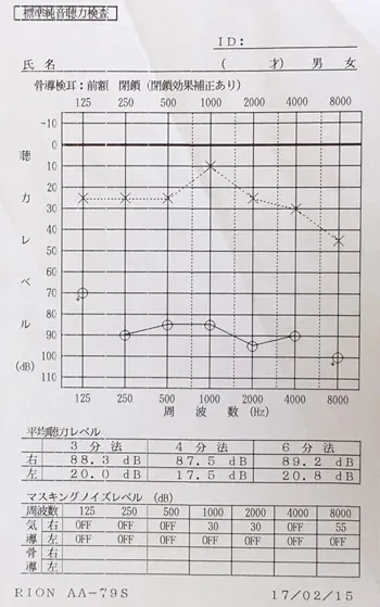 突発性難聴の原因｜ストレスで血流が低下した顔（治療前）