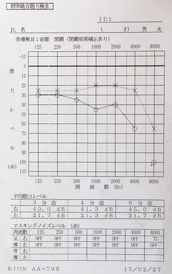 突発性難聴の原因｜鍼治療で血流が改善した顔（治療後）