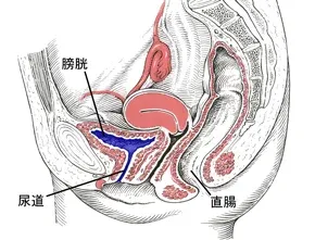 間質性膀胱炎（治療前）