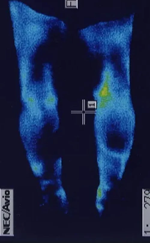筋繊維の太さの違いを調べるエコー検査
