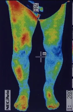 治療後、炎症が治まった膝