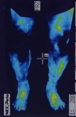 炎症を起こしていて、動きが悪い（温度が高い）状態の膝