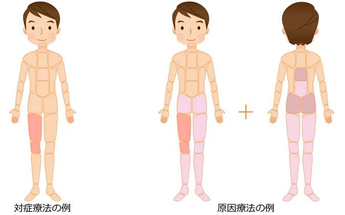 後十字靭帯損傷の治療｜対症療法｜原因療法の治療部位