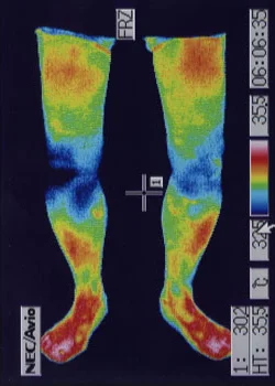 膝に水が溜まる｜治療後、膝の炎症がおさまったことが確認できる膝のサーモグラフィの様子