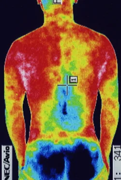 腰椎すべり症｜治療前、腰部の炎症が確認できるサーモグラフィの様子