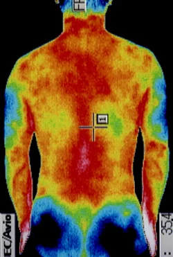 腰椎すべり症｜治療後、腰部の炎症がおさまったことが確認できるサーモグラフィの様子