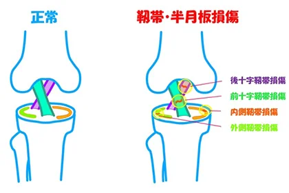 膝の構造と後十字靭帯損傷