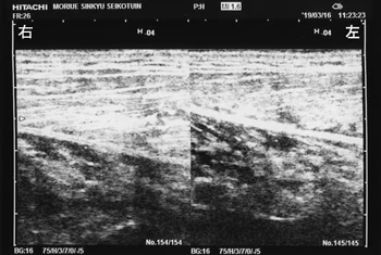 特発性骨壊死の検査｜軟部組織の損傷を調べます。