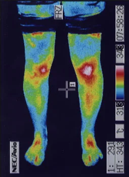 離断性骨軟骨炎の検査｜筋肉の代謝異常を調べます。