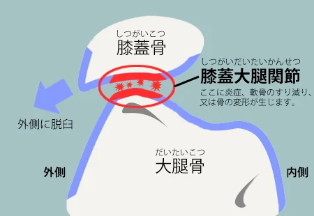 膝の構造と膝蓋大腿関節症