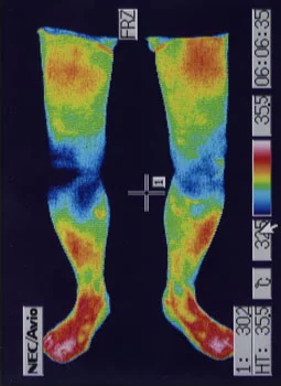 ロコモティブ症候群の原因｜左右の筋力低下や関節炎の温度分布（治療後）