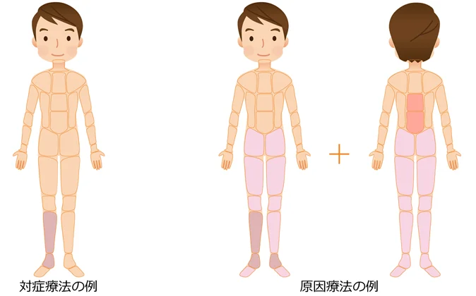 有痛性外脛骨の治療｜対症療法｜原因療法の治療部位