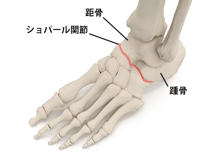 ショパール関節捻挫の鍼治療