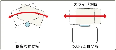 つぶれた椎間板