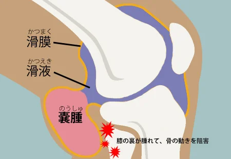 膝の構造とベーカー嚢腫