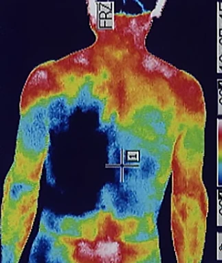 ラムゼイ・ハント症候群｜自律神経の異常を調べるサーモグラフィの検査