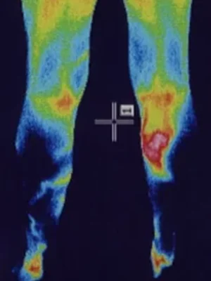 強膜炎｜強膜炎の血流異常を調べるサーモグラフィー検査