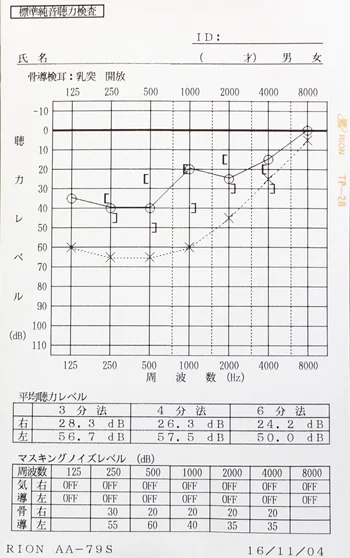 急性低音障害型感音難聴の鍼治療/オージオグラム