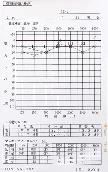 急性低音障害型感音難聴の鍼治療/オージオグラム