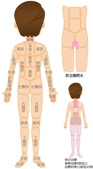 前立腺肥大｜対症療法と原因療法の治療部位