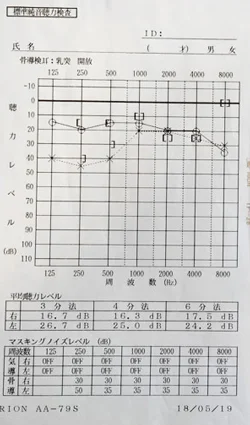 若年発症型両側性感音難聴で埼玉県から通院されたJ.S.様の治療前のオージオグラム