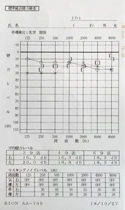 若年発症型両側性感音難聴が良くなったJ.S.様のオージオグラム