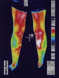 耳梗塞の原因になるふくらはぎの血流が改善したサーモグラフィー