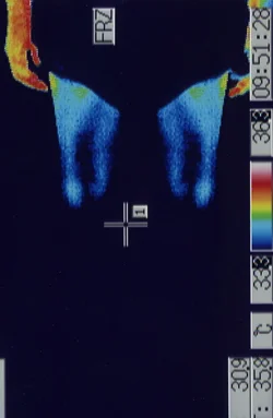 痙性斜頸の原因となるストレスで温度が低下したふくらはぎのサーモグラフィー