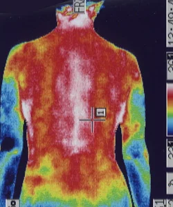 むち打ち症｜カラダの温度分布（治療前）