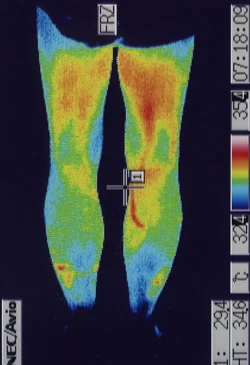 腰椎分離すべり症の手術後に悪化した腰痛のサーモ画像（治療後）