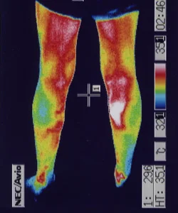 鍼治療で足の温度と血流良くなり自律神経が安定した足のサーモグラフィー