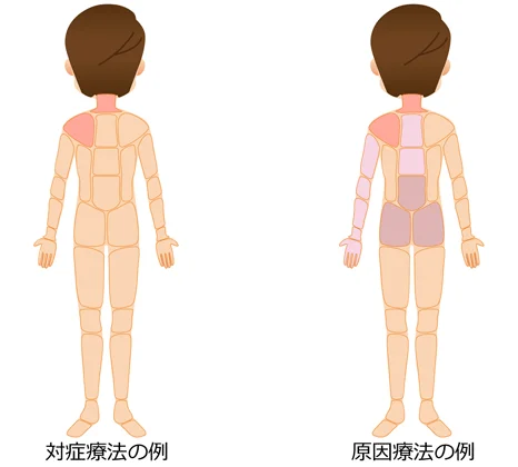 対処療法 原因療法の治療部位