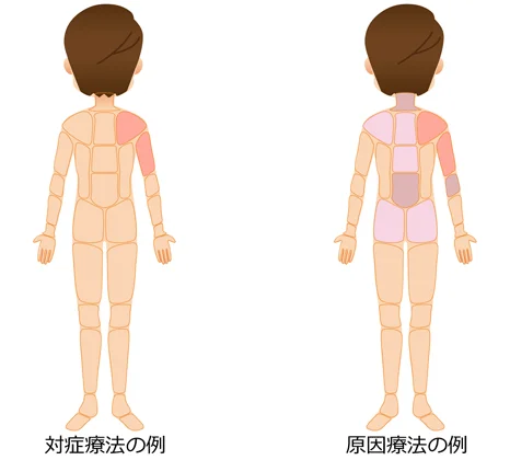 対症療法 原因療法の治療部位