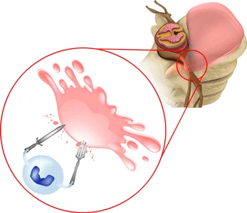 椎間板ヘルニアを食べる食細胞