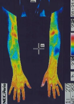 テニス肘｜鍼治療で良くなった手の炎症