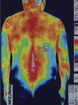背中の痛み｜背中の温度分布（治療後）