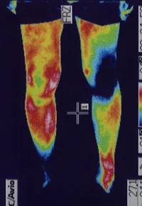 小学生の捻挫 サーモグラフィー（足）