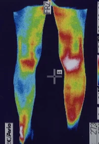 小学生の捻挫 サーモグラフィー（足）