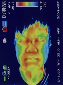 群発頭痛の原因｜筋力低下や腕から手にかけての温度分布（治療後）