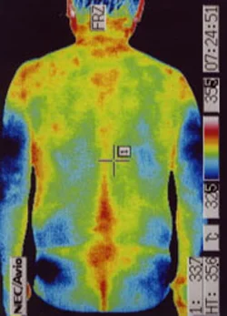 筋ジストロフィーの原因｜自律神経異常｜背部の温度分布（治療後）