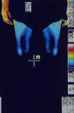 顔面神経麻痺の原因|ふくらはぎの血流(治療前)