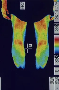 顔面神経麻痺の原因|ふくらはぎの血流(治療後)