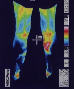 ストレスが原因で足の温度と血流が低下したサーモグラフィー