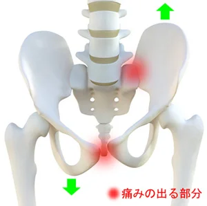 骨盤のズレで発生する痛み