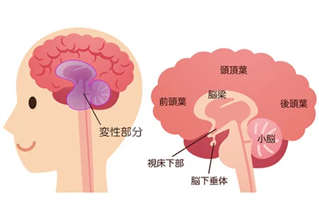 多系統萎縮症の鍼治療