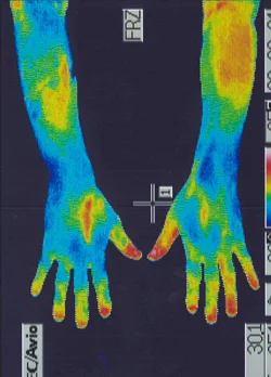 鍼治療後の手の温度