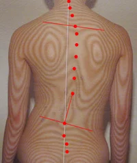 特発性側湾症の原因｜体の重心バランスの傾き（治療前）