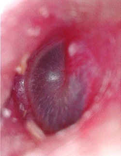 鍼治療で治った突発性難聴の鼓膜の画像