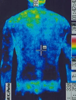 突発性難聴のステロイド治療で抵抗力が低下した背中のサーモグラフィ画像